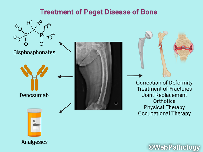 Bone_PagetDz_Treatment_Composite_resized.png