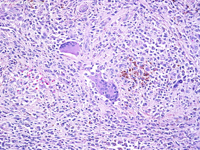 Bone_PigmentedVillonodularSynovitis1.jpg