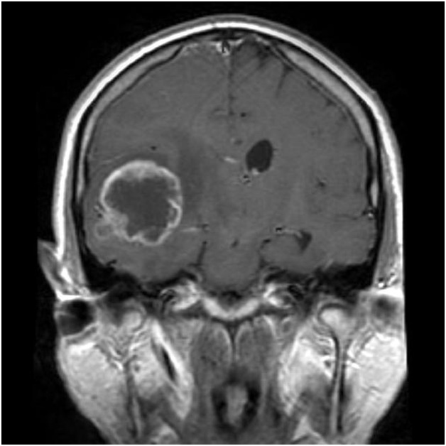 Brain_Astrocytoma_GBM_Radiology2(1).jpg