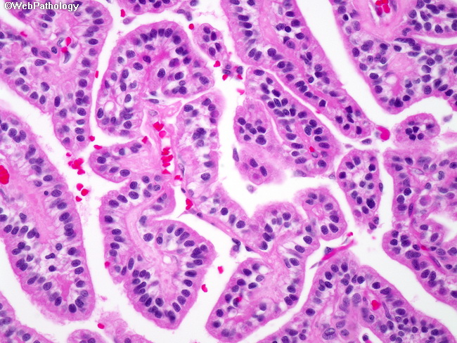 Oxiurose causa doenca - Atypical choroid plexus papilloma icd 10