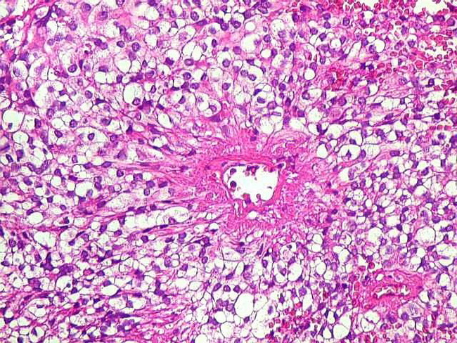 Brain_Ependymoma23_ClearCell_Unicamp.jpg