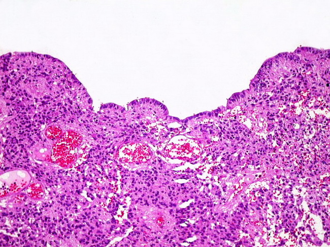 Brain_Ependymoma5_Canals_Unicamp.jpg