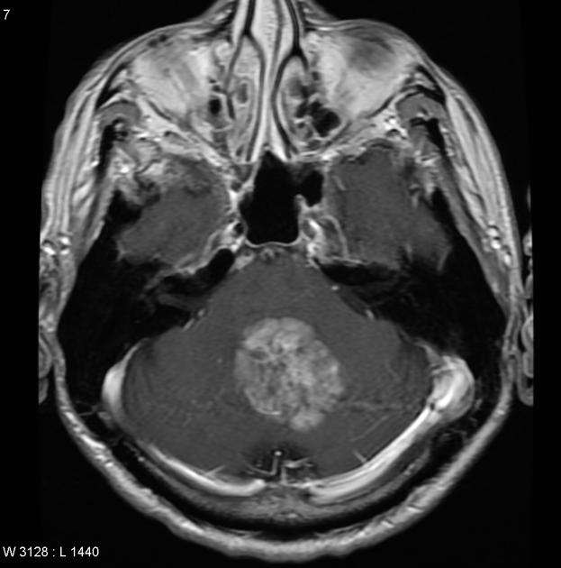Brain_Ependymoma_MRI2.jpg