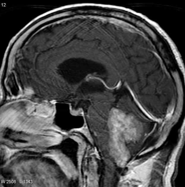 Brain_Ependymoma_MRI4.jpg