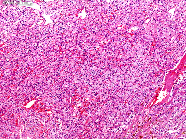 Brain_Hemangioblastoma1.jpg
