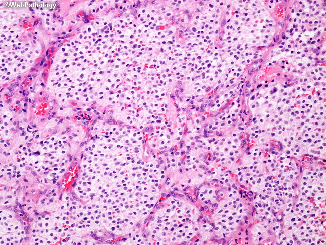 Brain_Hemangioblastoma18.jpg