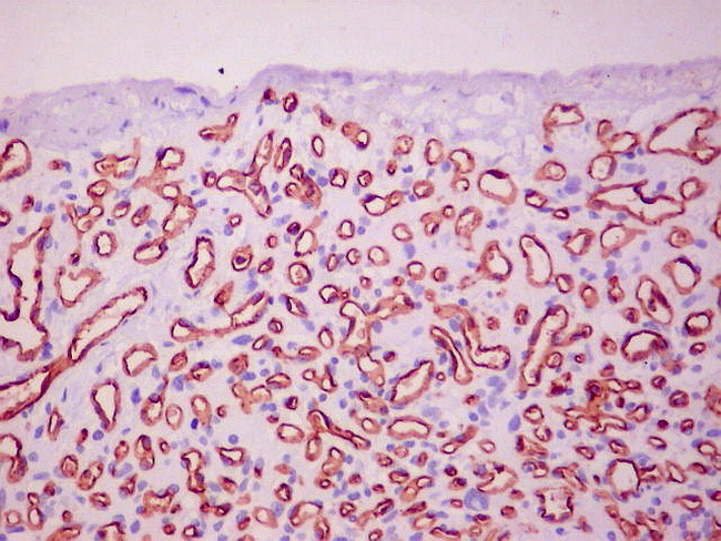 Brain_Hemangioblastoma30_CD31.jpg