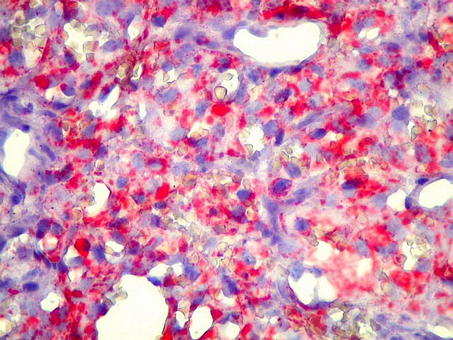 Brain_Hemangioblastoma32_OilRedO_Copy.jpg