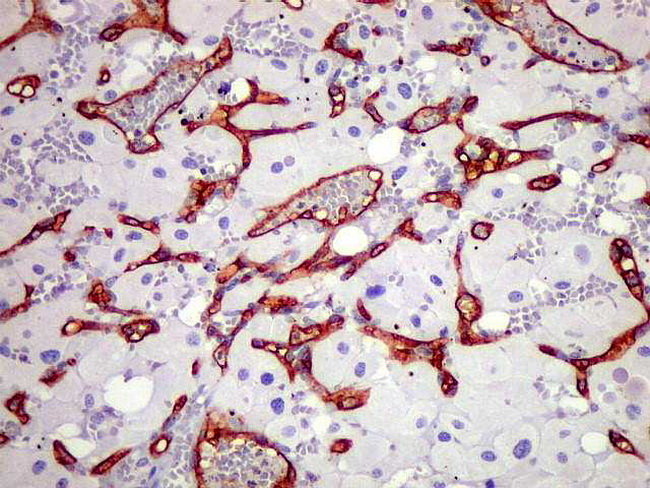 Brain_Hemangioblastoma33_CD34_Copy.jpg
