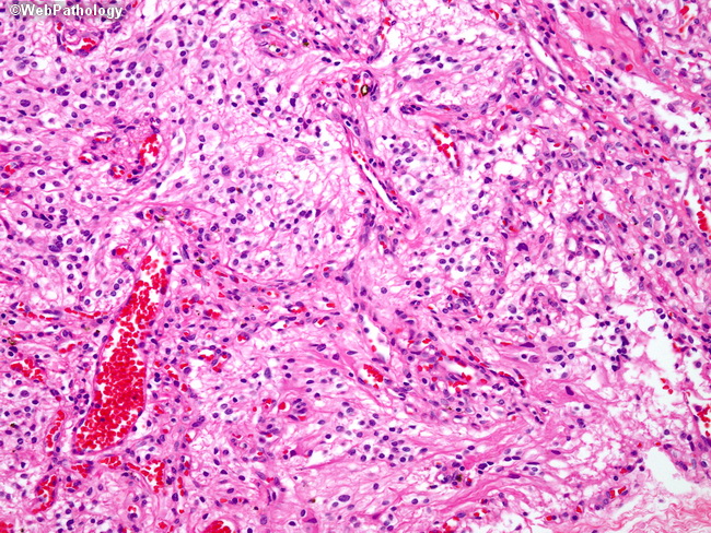 Brain_Hemangioblastoma5.jpg