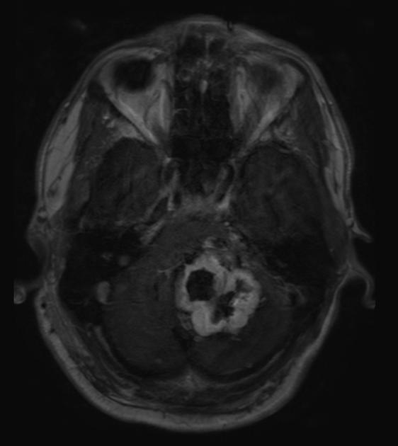 Brain_Hemangioblastoma_Radiology5.jpg
