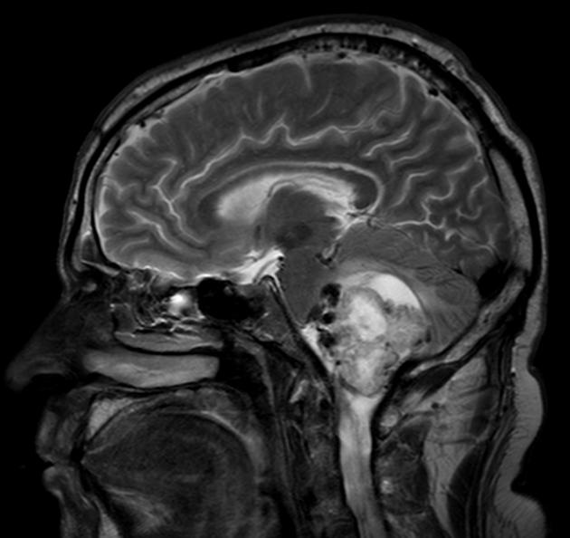 Brain_Hemangioblastoma_Radiology6.jpg
