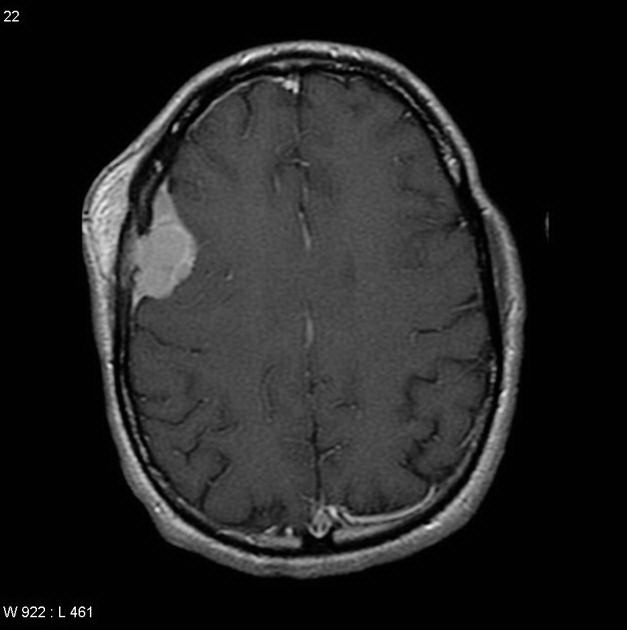 Brain_Meningioma_Radiology4.jpg