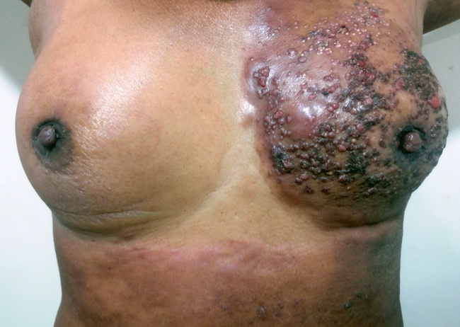 BreastCA_CarcinomaEnCuirasse3_resized.jpg