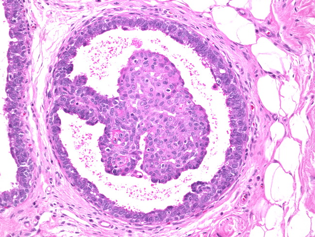 Papilloma és dcis, A mellrák kialakulása, leggyakoribb altípusok