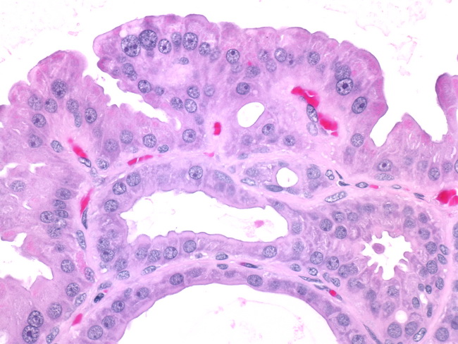 intraductal papilloma with atypia