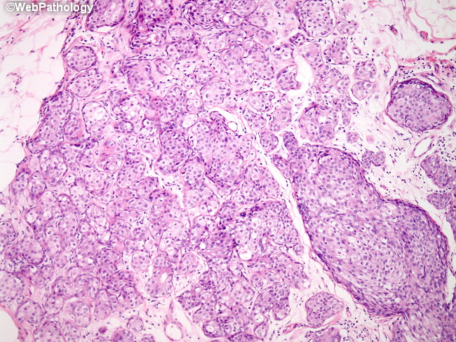 Breast_CA_LCIS9_ClearCells.jpg