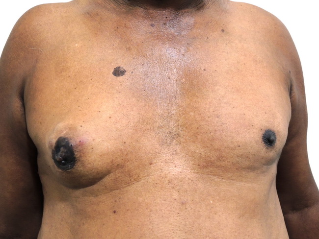 Breast_CA_Male_Clinical1_resized.JPG