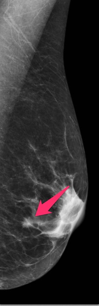 Breast_CA_Tubular10_Mammogram.jpg