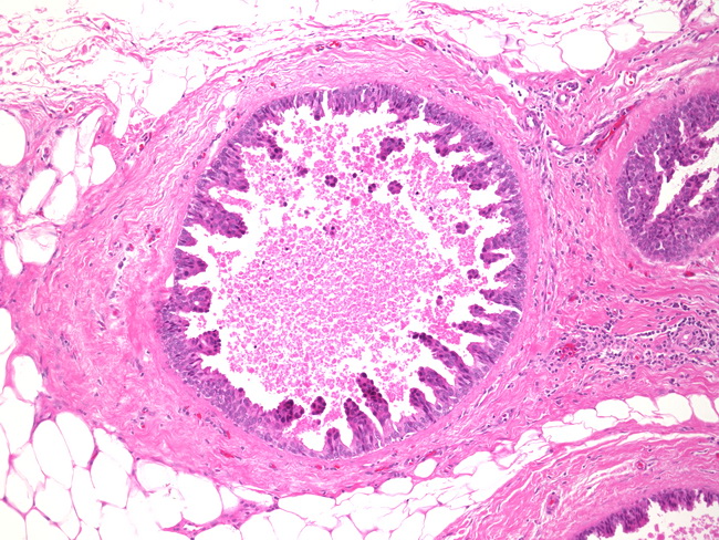 Breast_Carcinoma_DCIS4_Micropapillary.jpg