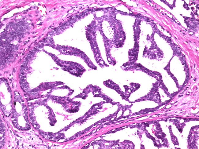 Breast_Carcinoma_DCIS6_Micropapillary.jpg