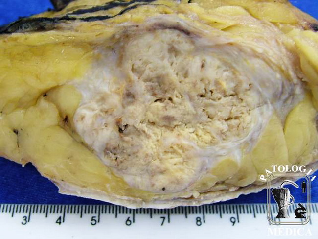 Breast_Carcinoma_Ductal_Infiltrating_Gross15_resized.jpg