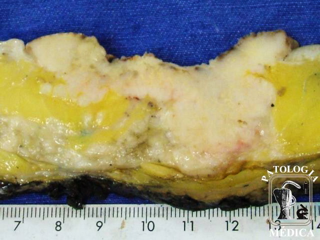 Breast_Carcinoma_Ductal_Infiltrating_Gross8_resized.jpg