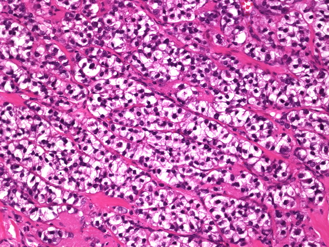 Breast_Carcinoma_GlycogenRich_ClearCell2.jpg