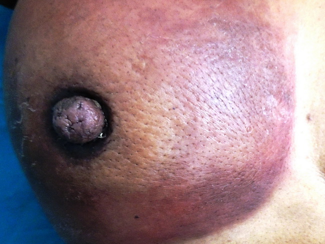 Breast_Carcinoma_Inflammatory2_resized.JPG