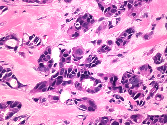 Breast_Carcinoma_Male1.jpg
