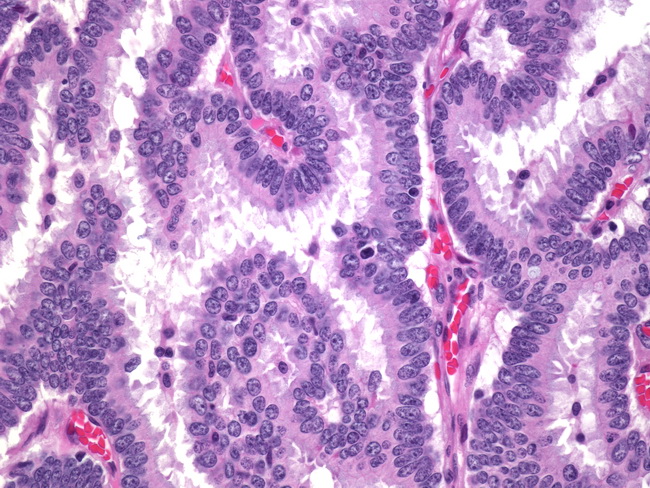 Breast_Carcinoma_Papillary3_Intracystic.jpg