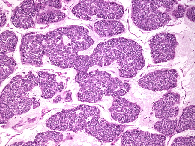 Breast_ColloidCarcinoma6.Case3.jpg
