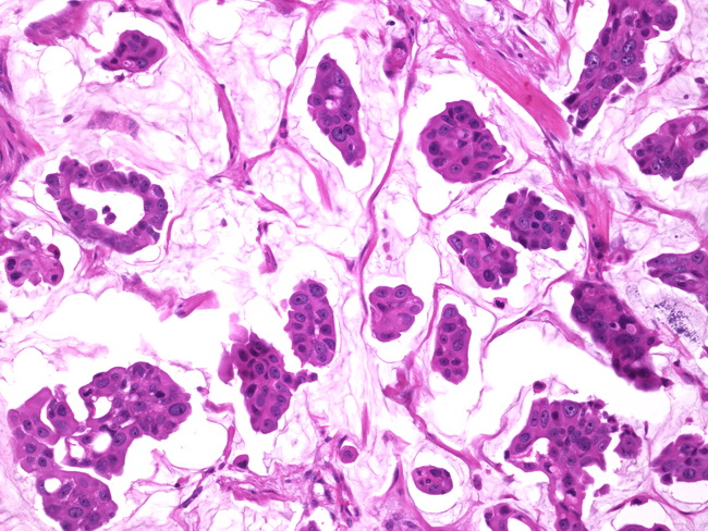 Breast_ColloidCarcinoma8.Case5.jpg