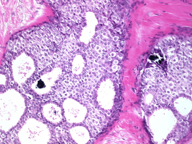 Breast_DCIS5_Microcalcifications.jpg