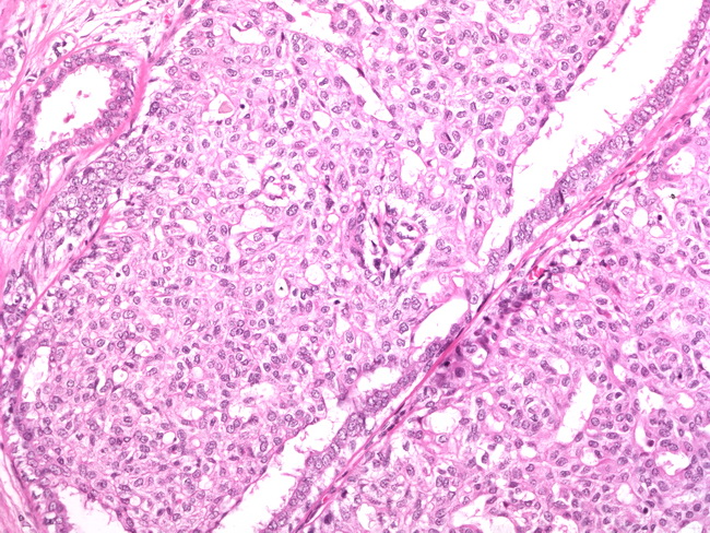 intraductal papilloma with usual ductal hyperplasia