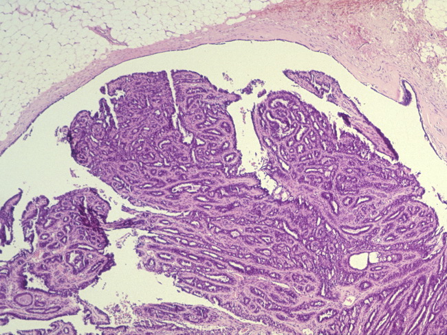 intraductal papillomatosis pathology cancer and genital warts