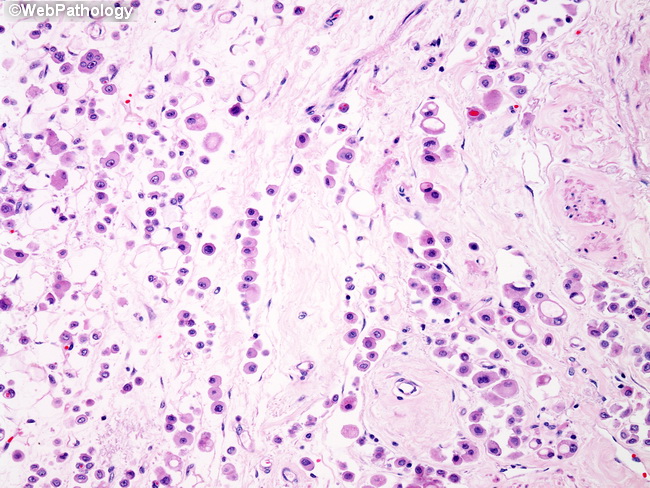 Breast_LobularCA45_Histiocytoid.jpg