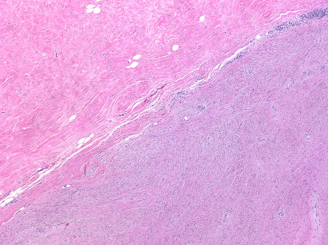 Breast_Myofibroblastoma1.jpg
