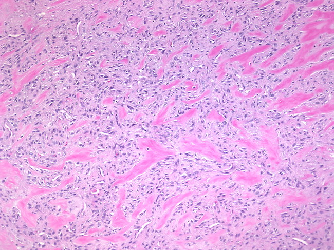 Breast_Myofibroblastoma2.jpg