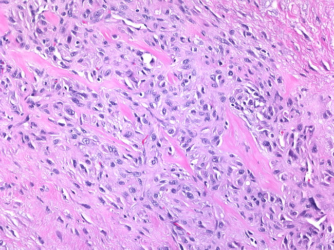 Breast_Myofibroblastoma3.jpg