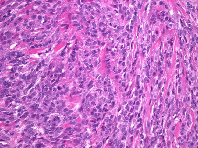 Breast_Myofibroblastoma6_Epithelioid.jpg