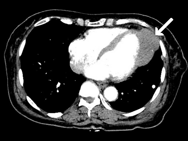 CardiacFibroma_Radiology1_resized.jpg