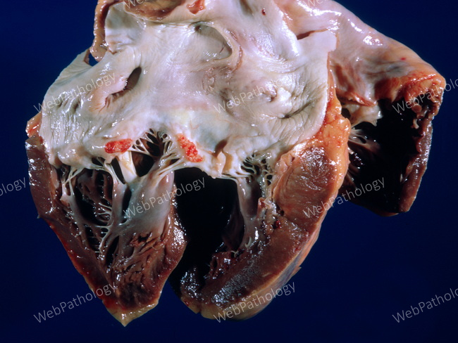 Cardiovascular_Endocarditis_Non-Bacterial1_cropped.jpg