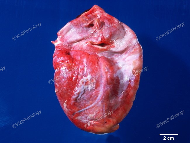Cardiovascular_Pericarditis_Fibrinous2_resized.jpg