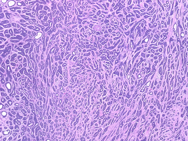 Adenoid cysticus carcinoma