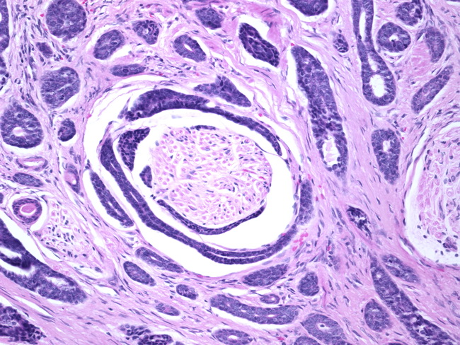 Cervix_AdenoidCysticCarcinoma3_PNI.jpg