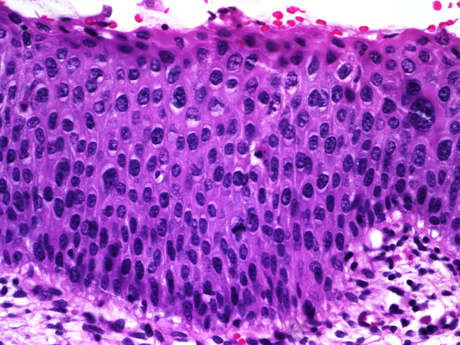 Squamous papilloma with severe dysplasia