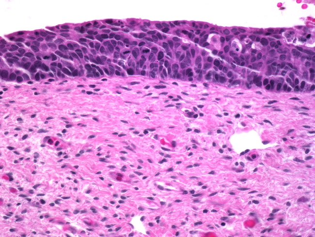 squamous cell carcinoma in situ histology