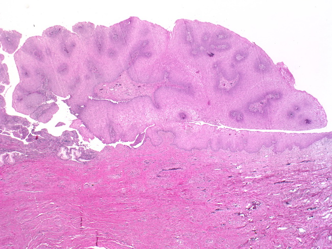 Condyloma acuminatum vulva histology