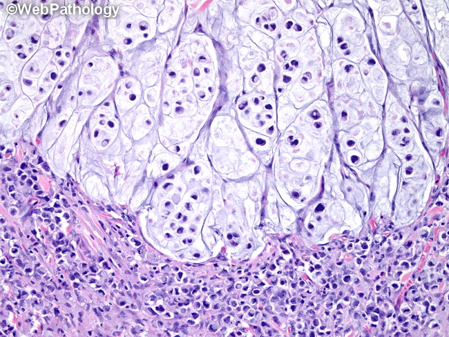 Poorly cohesive cells gastric carcinoma including signet-ring cell cancer:  Updated review of definition, classification and therapeutic management